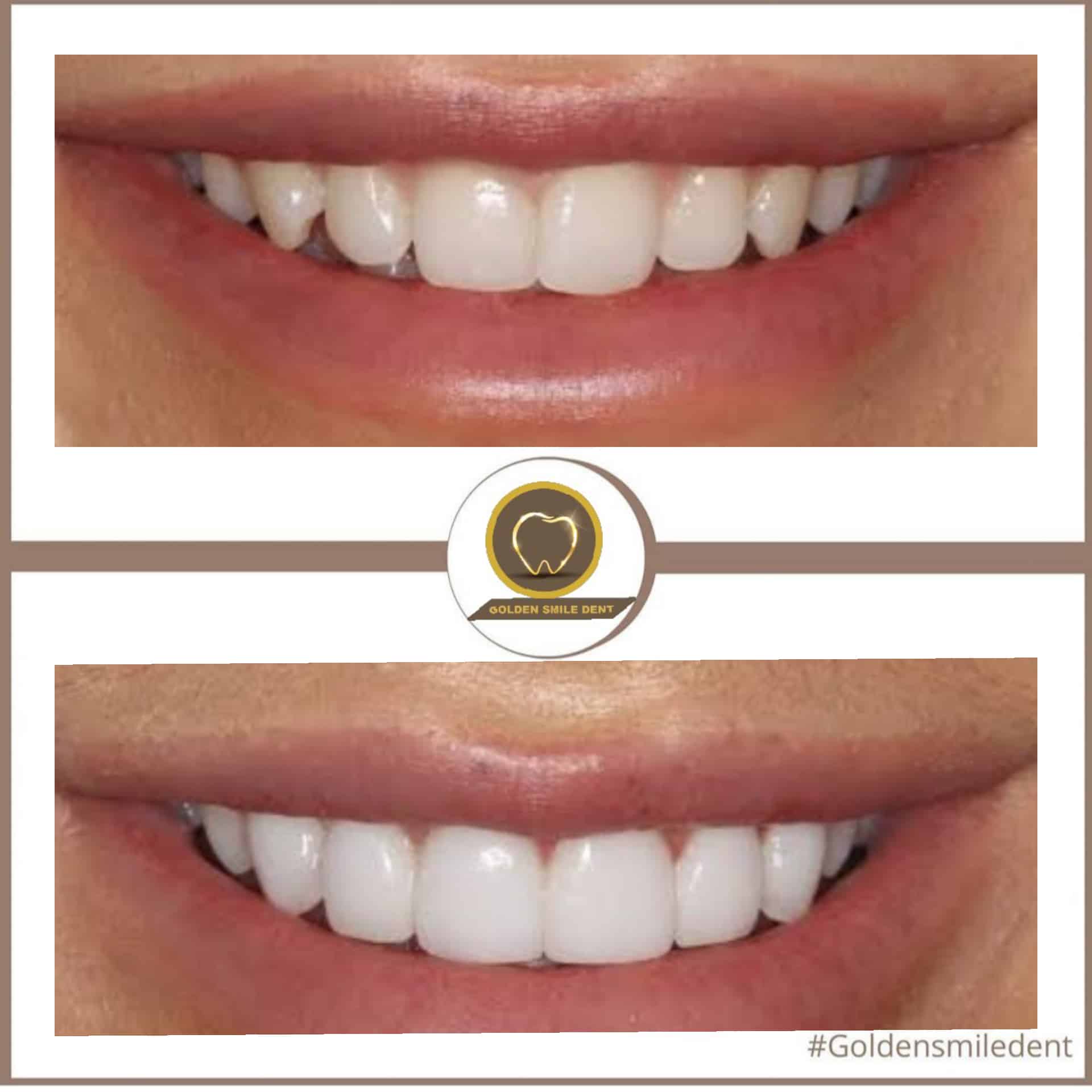 Zirkonyum Kaplama Fiyatları | Golden Smile - Dental Implant Ve Estetik ...